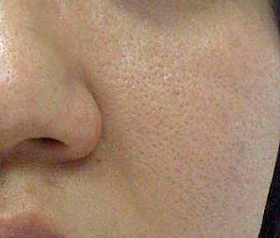 بستن منافذ باز روی پوست با روشی ساده